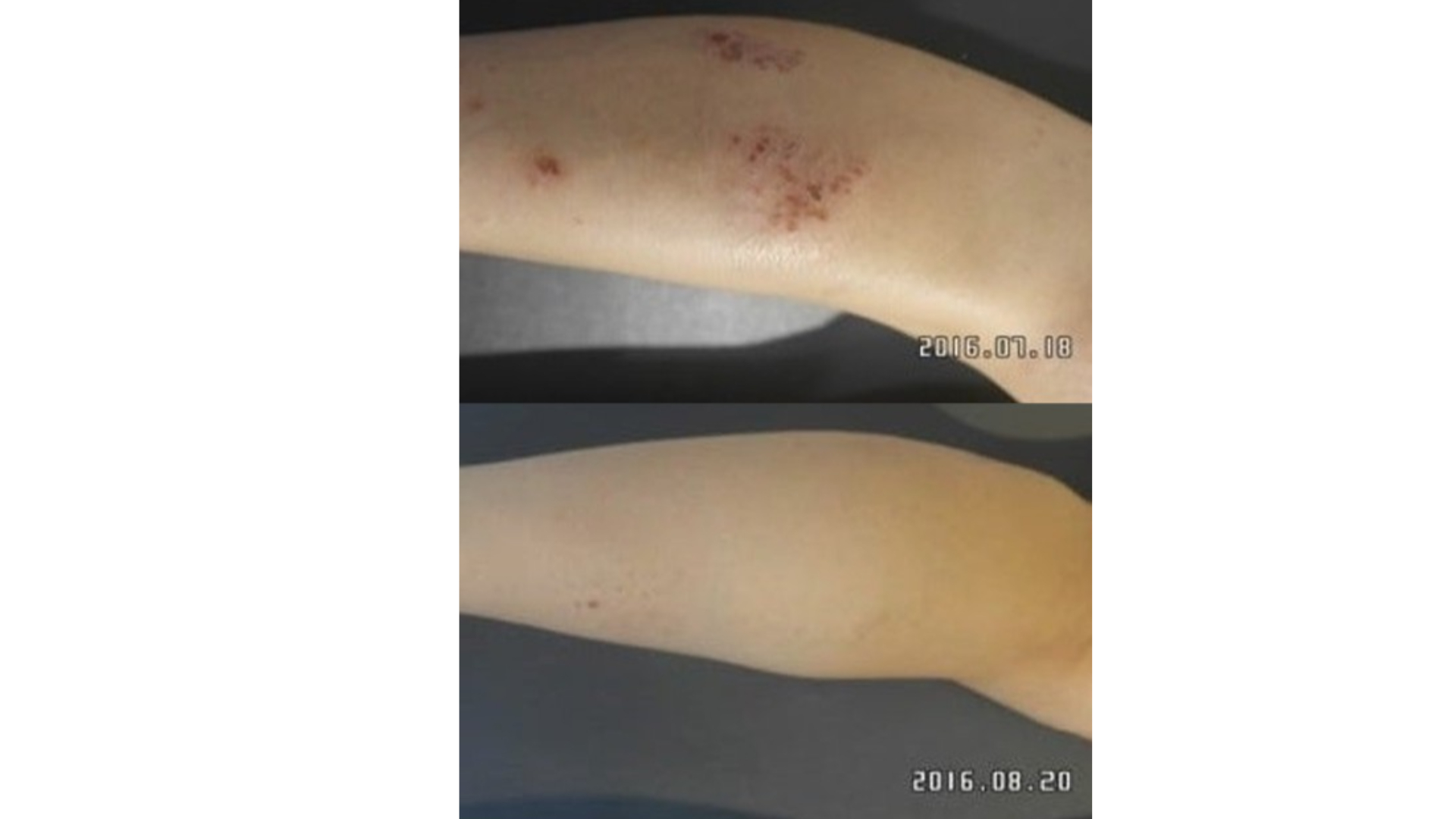 종아리 화폐상습진 여기저기 가려운 이유?