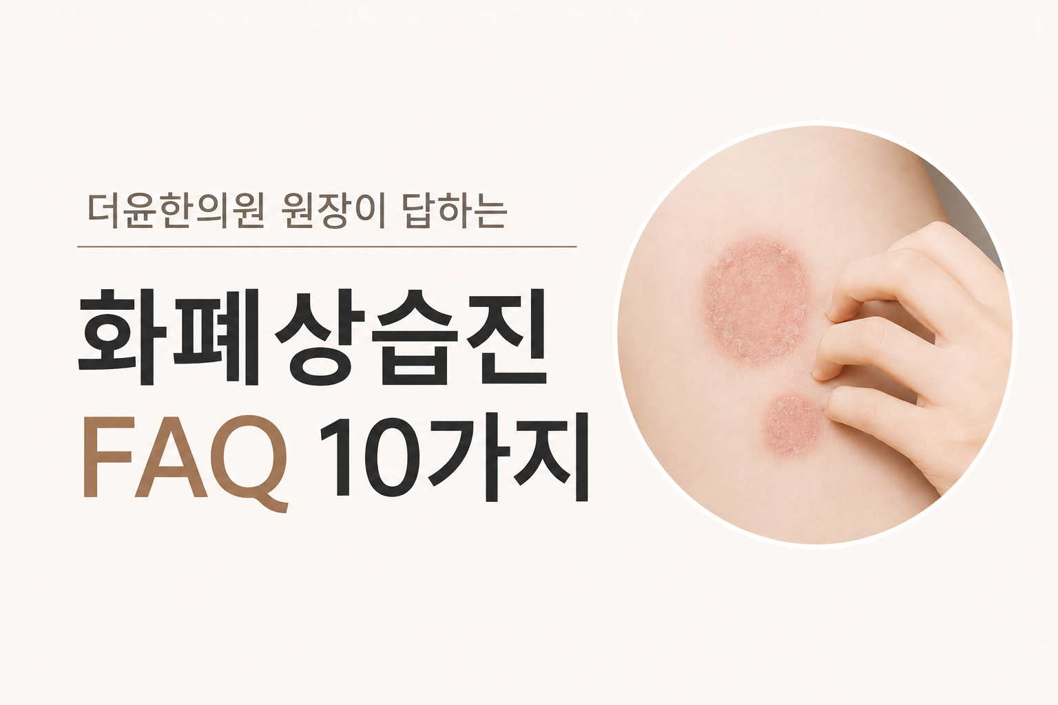 화폐상습진 왜 생길까요? 진물·가려움부터 치료와 관리법까지 FAQ 10가지