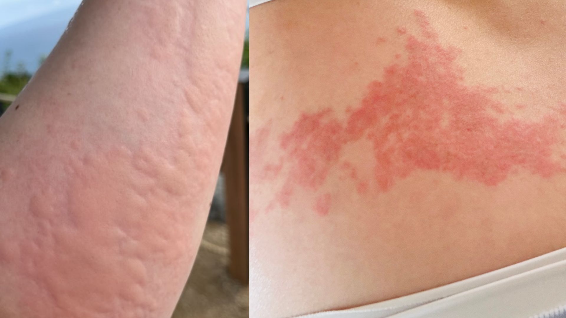 운동하거나 땀나면 두드러기가 생기는 이유｜콜린성 두드러기 원인과 치료