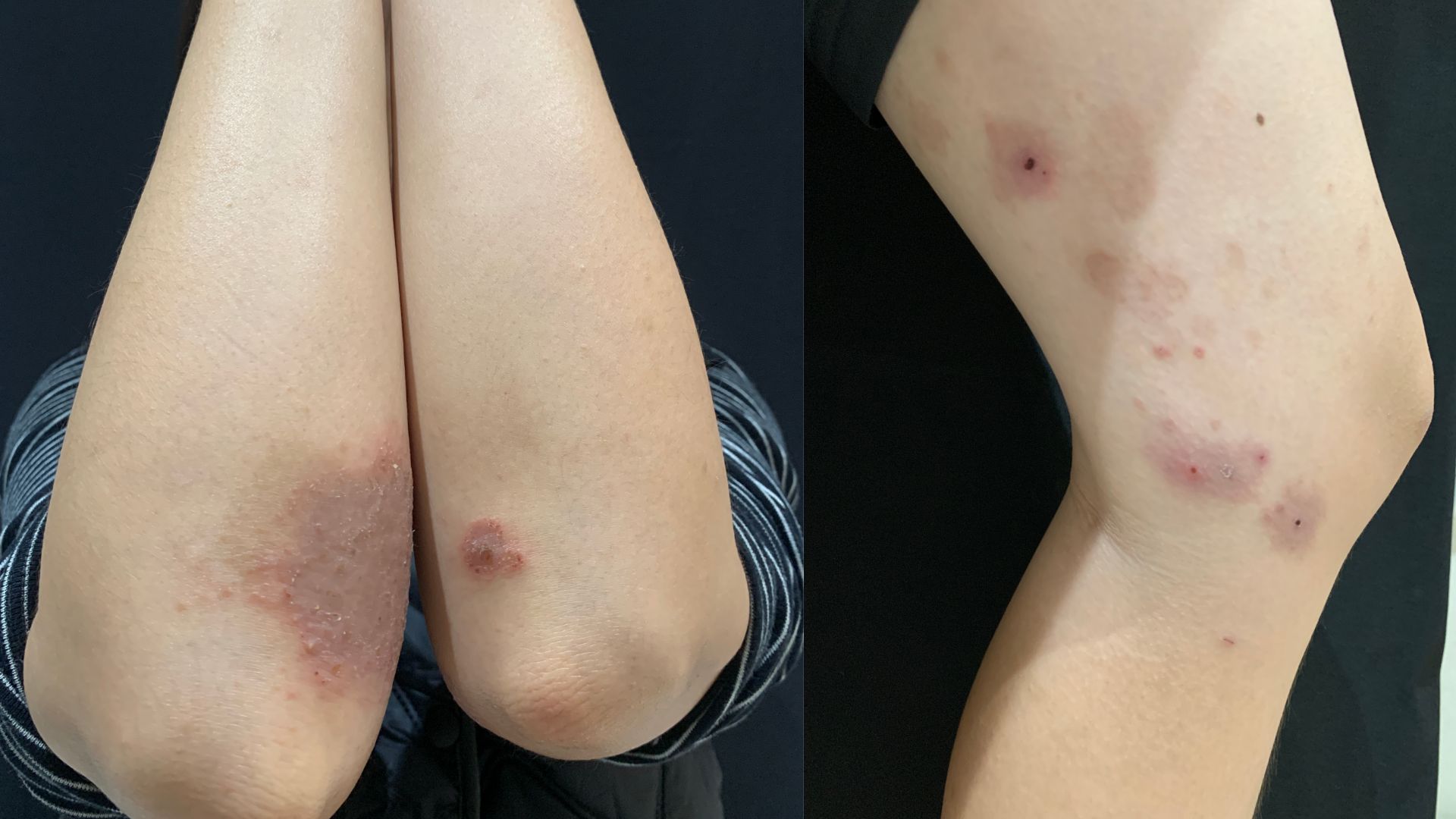 온 몸이 가려운데 점점 번지는 이유, 화폐상습진이 맞나요?